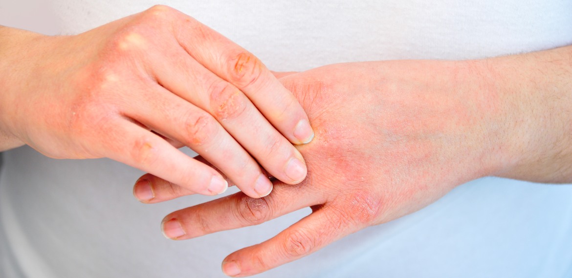 Eccessiva secchezza della pelle e delle mani? Le cause