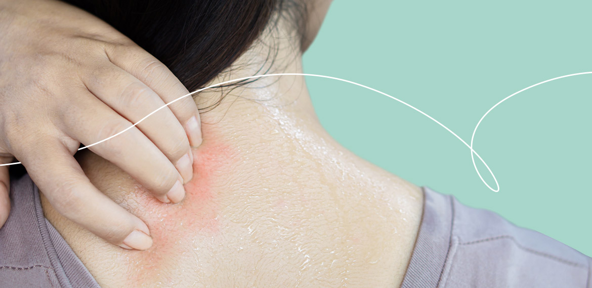 Dermatite da sudore: come si presenta e quali sono i rimedi