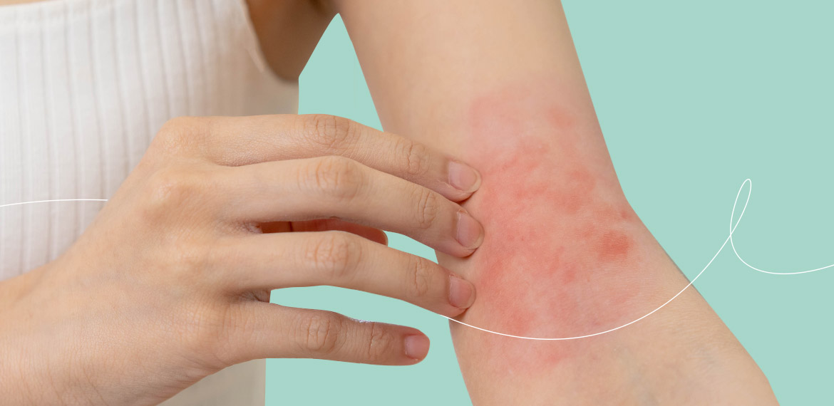 Dermatite atopica tra cause, sintomi e serena convivenza